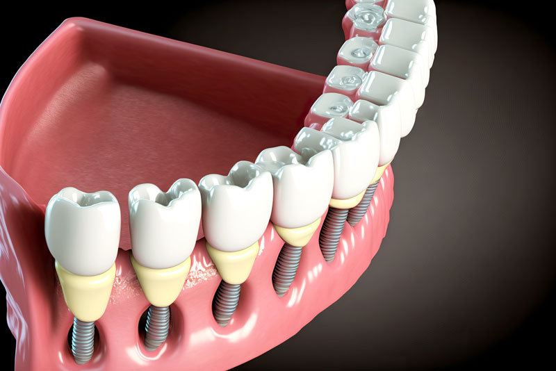 Are Dental Implants Able To Restore My Smile?