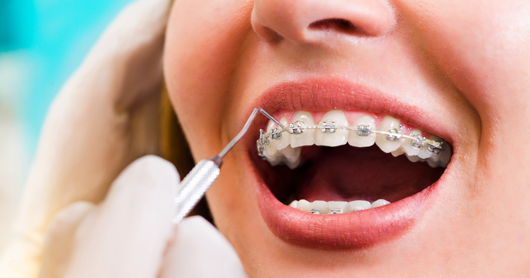 Does Dental Insurance Cover Orthodontics?