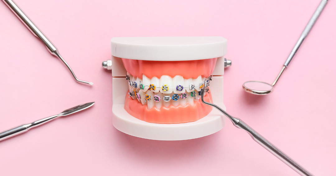 Which Type of Braces is Right for You?