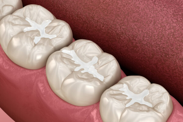 Molar Fissure dental fillings, Medically accurate 3D illustratio
