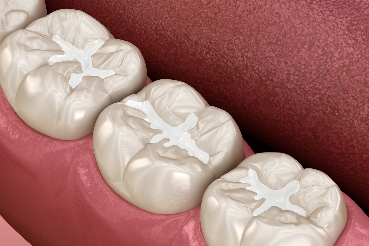 What Are Dental Sealants?