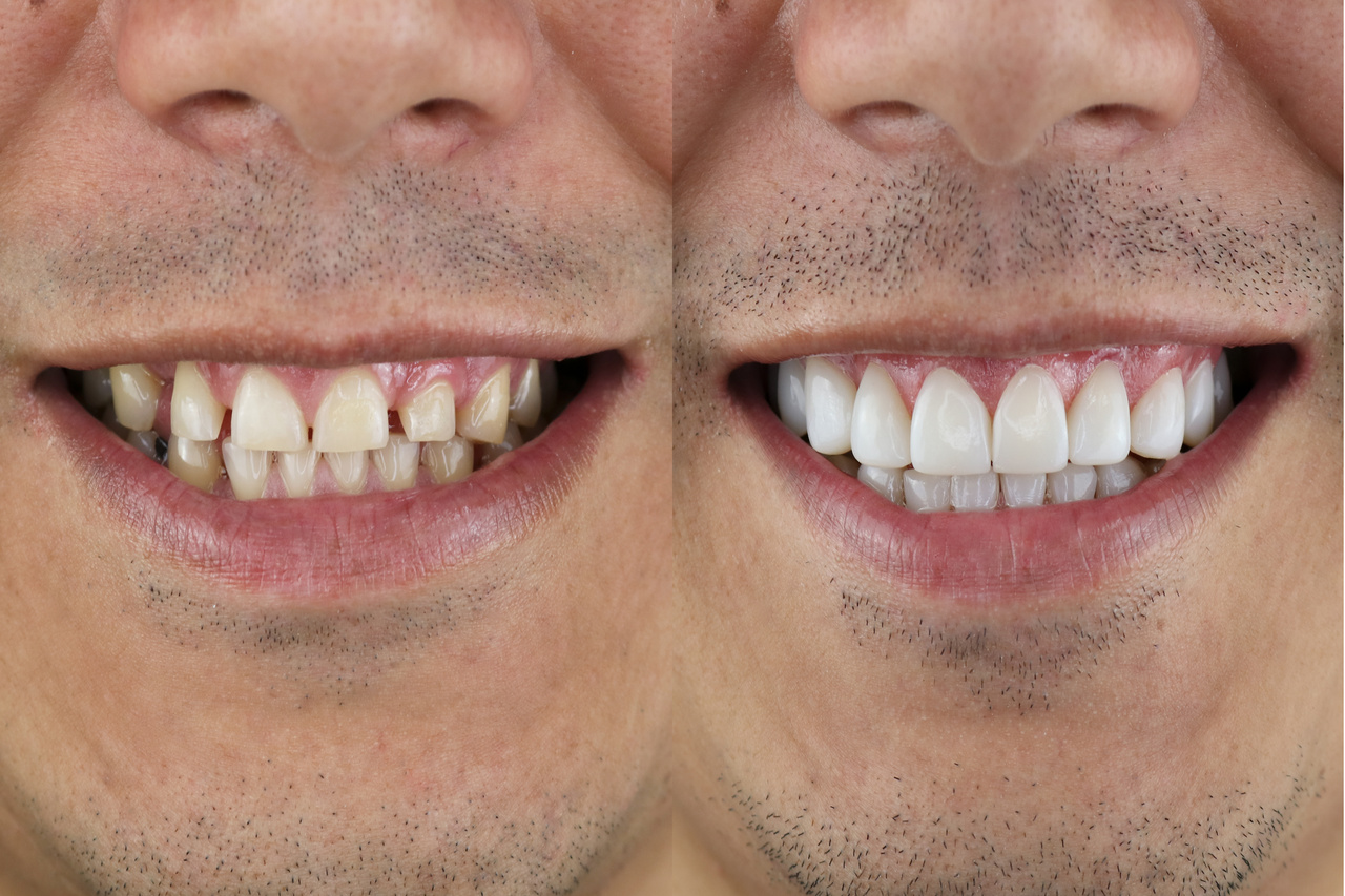 What Is a Smile Makeover and How Can It Improve Your Smile?