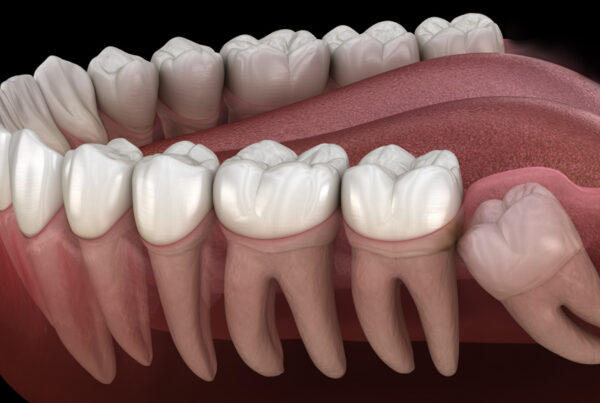 wisdom tooth